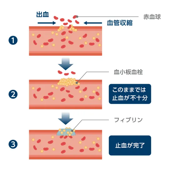 図:血友病と止血の仕組み