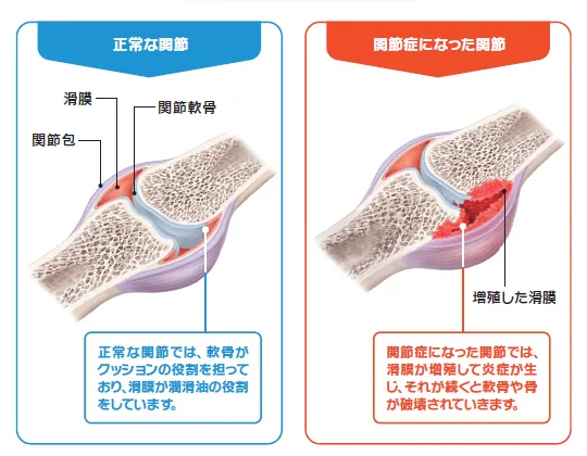 説明イラスト:正常な関節と関節症になった関節