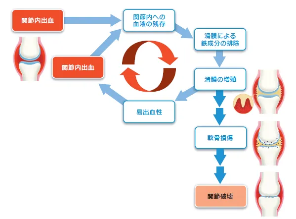 説明イラスト:血友病性関節症が起こるメカニズム