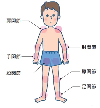 説明イラスト:血友病性関節症・関節内出血が起こりやすい関節