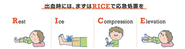 説明イラスト：出血時には、まずはRICEで応急処置を