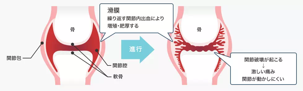 【図1】血友病性関節症