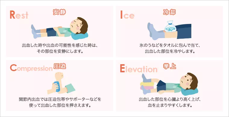 説明イラスト:出⾎時の補助的ケア:RICE