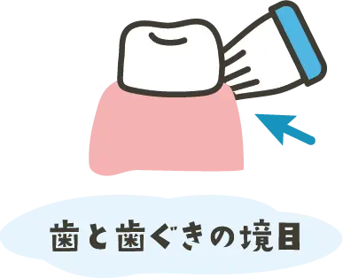 説明イラスト:歯と歯ぐきの境目