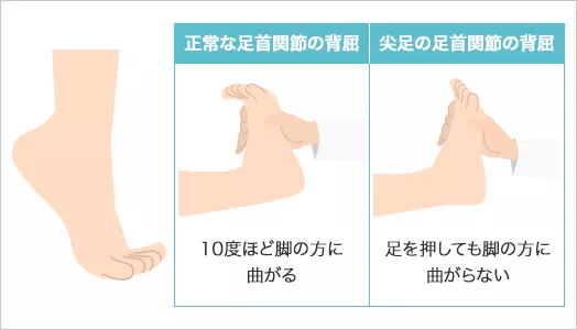 図:尖足